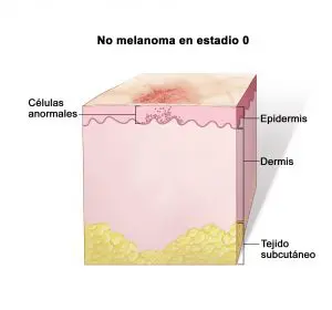 Melanoma maligno