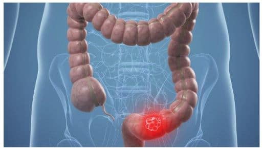 Síntomas del cáncer de colon
