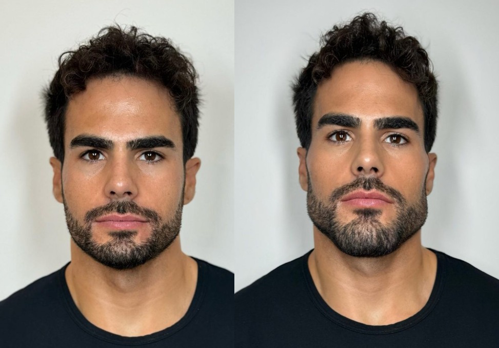 Masculinización facial: Potencia tu atractivo con Mandíbula de Diamante